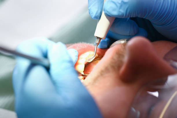 Best Emergency Tooth Extraction in Louisburg, NC