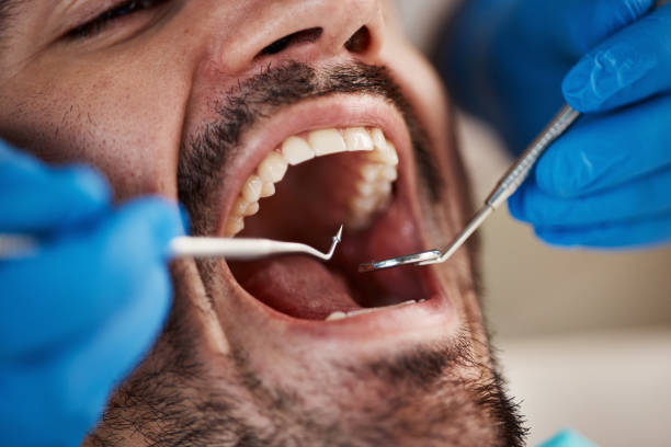 Best Emergency Wisdom Teeth Removal in Louisburg, NC